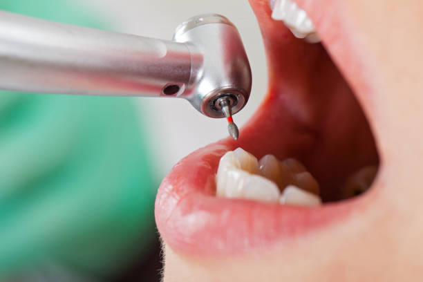 Best Emergency Dentist for Knocked-Out Tooth in Monroeville, AL